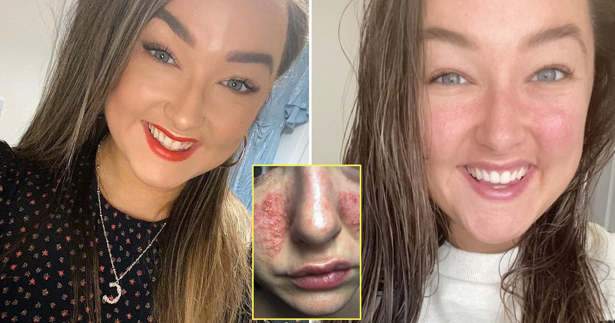 untitled 97.jpg?resize=412,275 - Woman Cured Her Rosacea Using A Face Cream Made Of Capers Within A Few Days