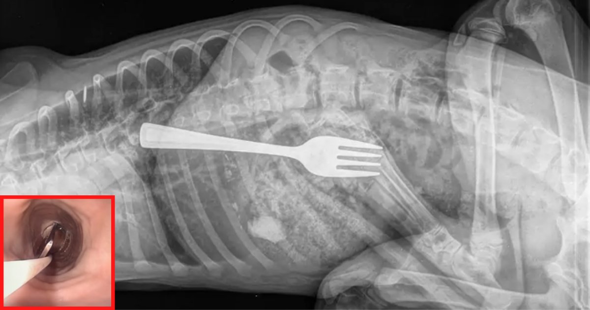 untitled design 1 4.png?resize=412,275 - Dog Swallows A Metal Fork And Doctors Remove It Using A Minimally Invasive Procedure