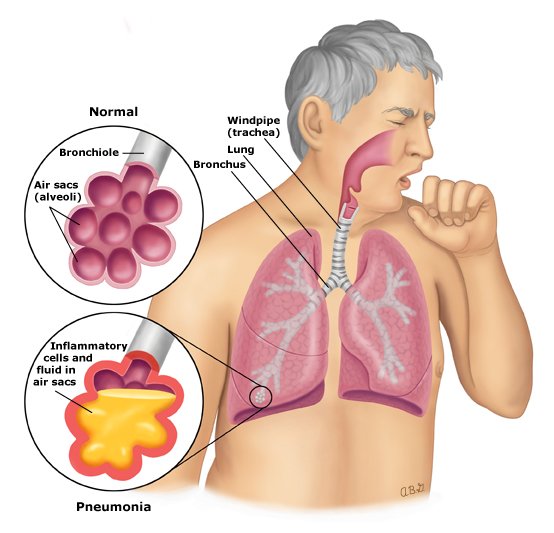 Pneumonia anatomy PI