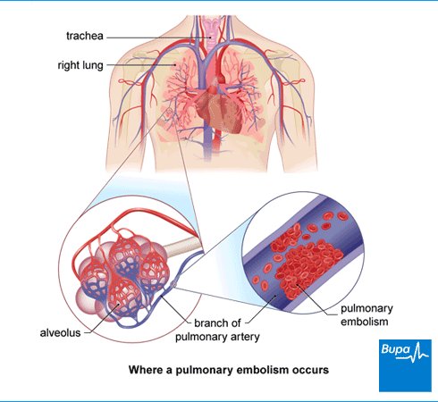 what is pulmonary embolism?