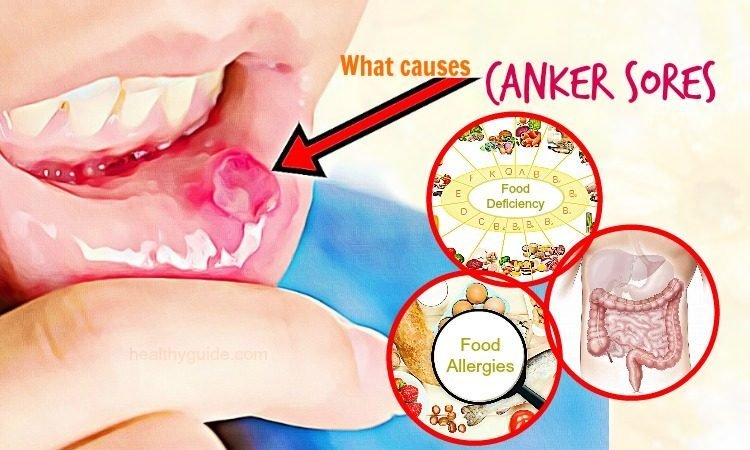 Canker Sore: Guide To Treating And Preventing The Painful Sensations