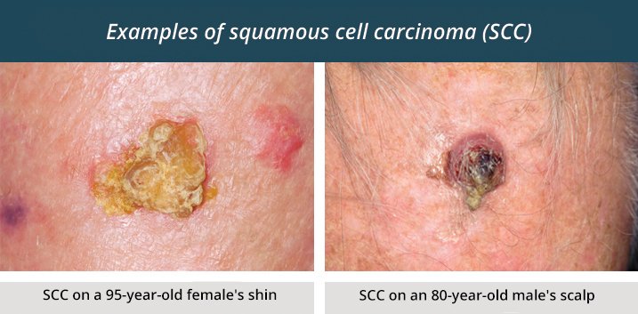 Squamous Cell Carcinoma