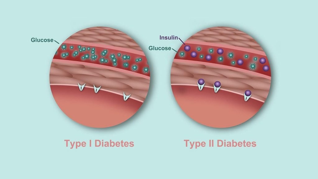 what is the difference between type 1 and type 2 diabetes