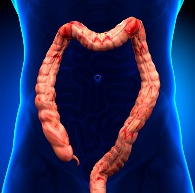 Ulcerative colitis