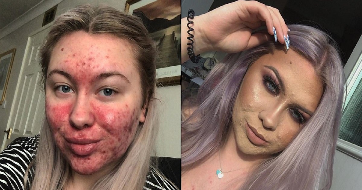 a3 12.jpg - Student Refused To Date Anyone Fearing She Would Be Rejected Because Of Her Severe Acne Problem