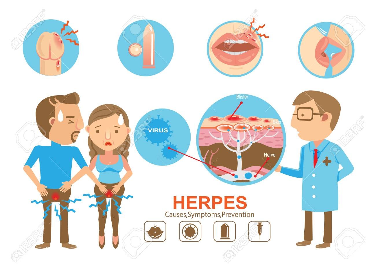 genital herpes