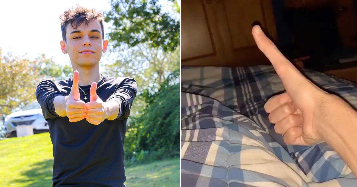 5 inch thumb guy.jpg?fit=1024%2C538&ssl=1&strip=all - Man With 5 Inch Thumb Exists And He’s Taking Over The World