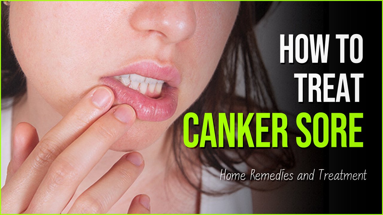 canker sore.jpg?resize=412,275 - Canker Sore: Guide To Treating and Preventing The Painful Sensations