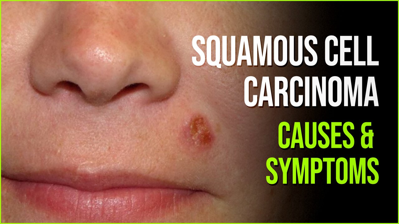 Squamous Cell Carcinoma Second Most Common Type Of Cancer