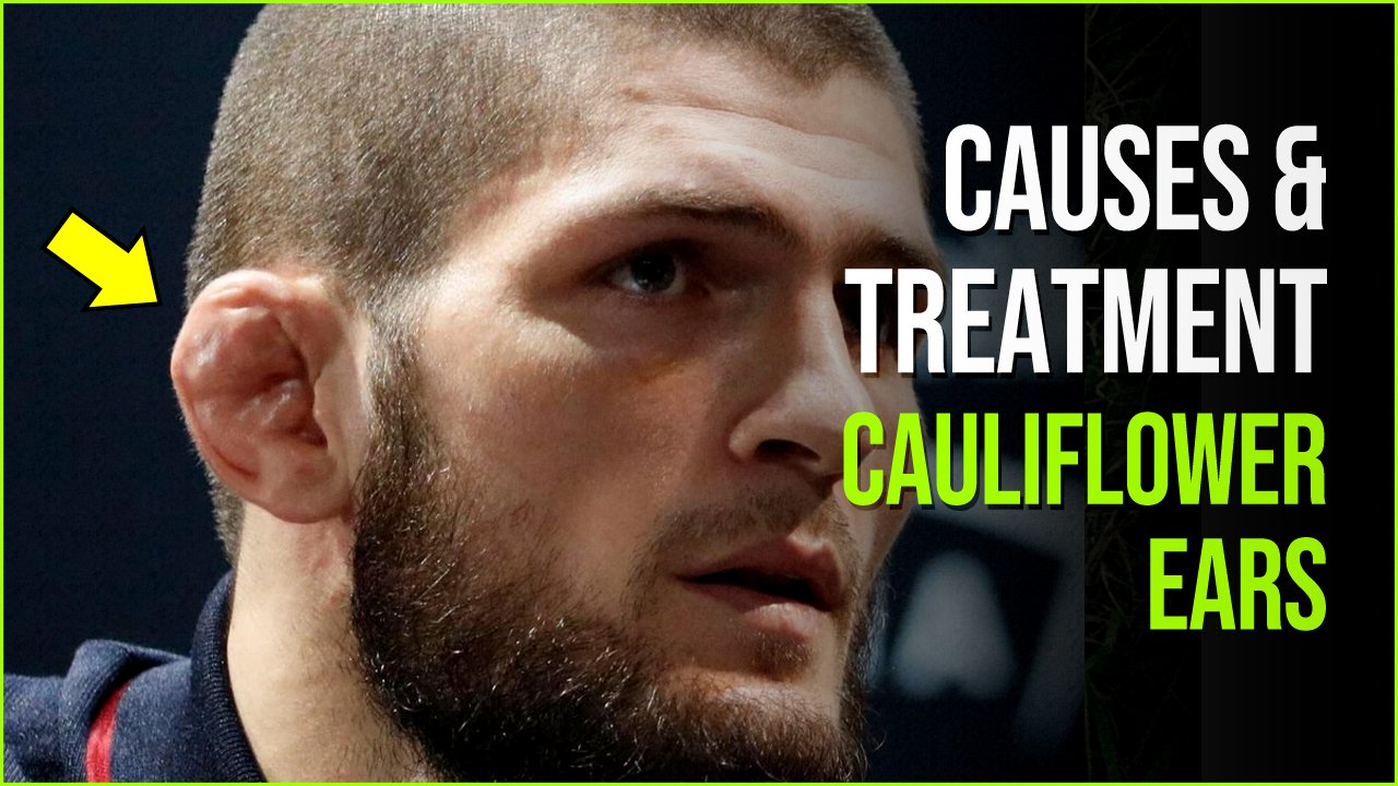 cauliflower ear.jpg?resize=412,275 - Cauliflower Ear: Causes, Symptoms And Treatment Of It