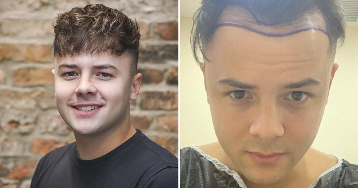 luke6.png?resize=412,232 - 26-Year-Old Man Left Scarred After Botched Hair Transplant
