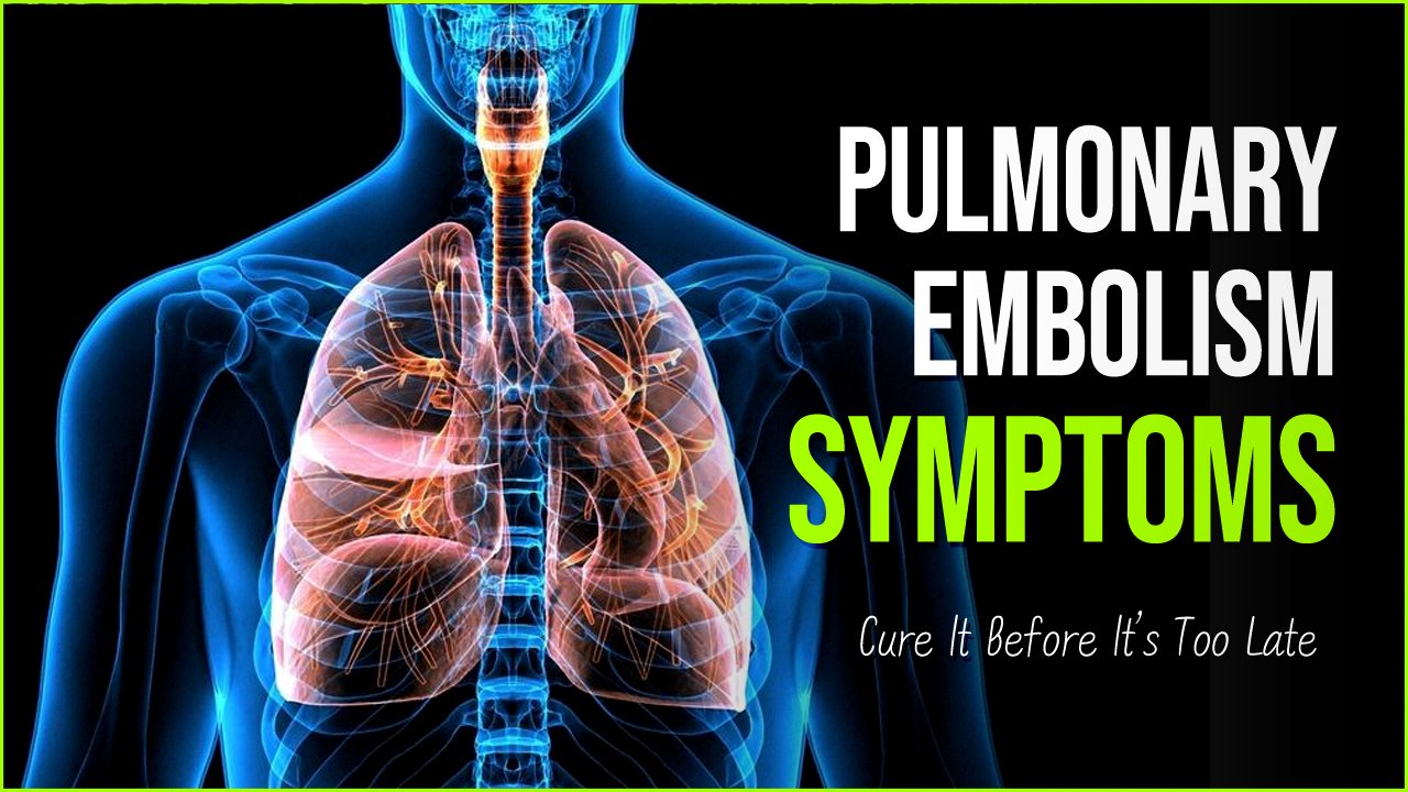 pulmonary empolism.png?resize=412,275 - Pulmonary Embolism: Cure It Before Its Too Late For Your Life