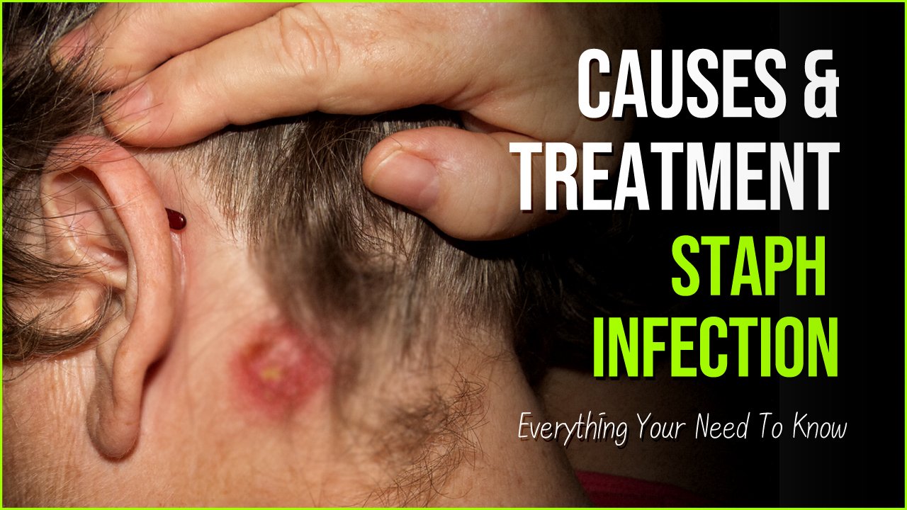 staph infection 1.jpg?resize=412,275 - Staph Infection: Causes, Symptoms, And Identifiable Risk Factors