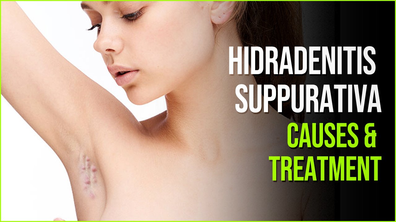 suppurativa.jpg?resize=412,275 - Hidradenitis Suppurativa - The Skin Disease You Should Be Careful Of