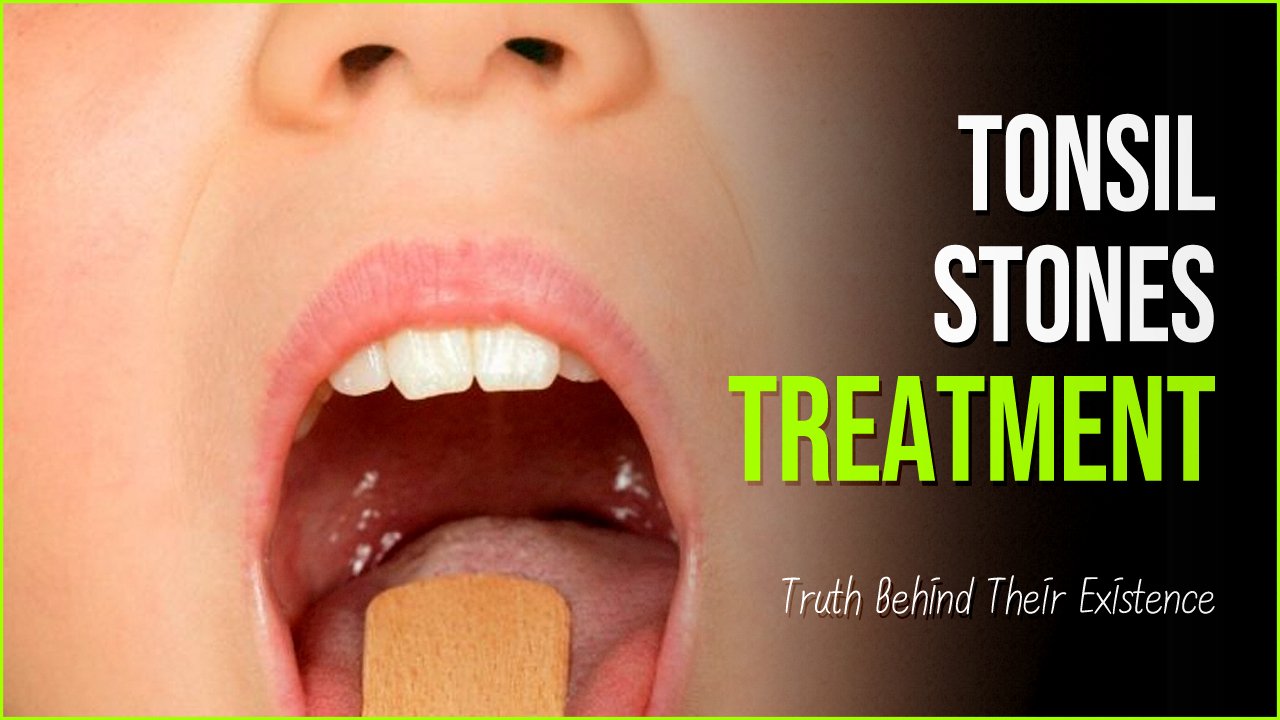 tonsil stones.jpg?resize=412,275 - Tonsil Stones: The Truth Behind Their Existence And How To Treat Them