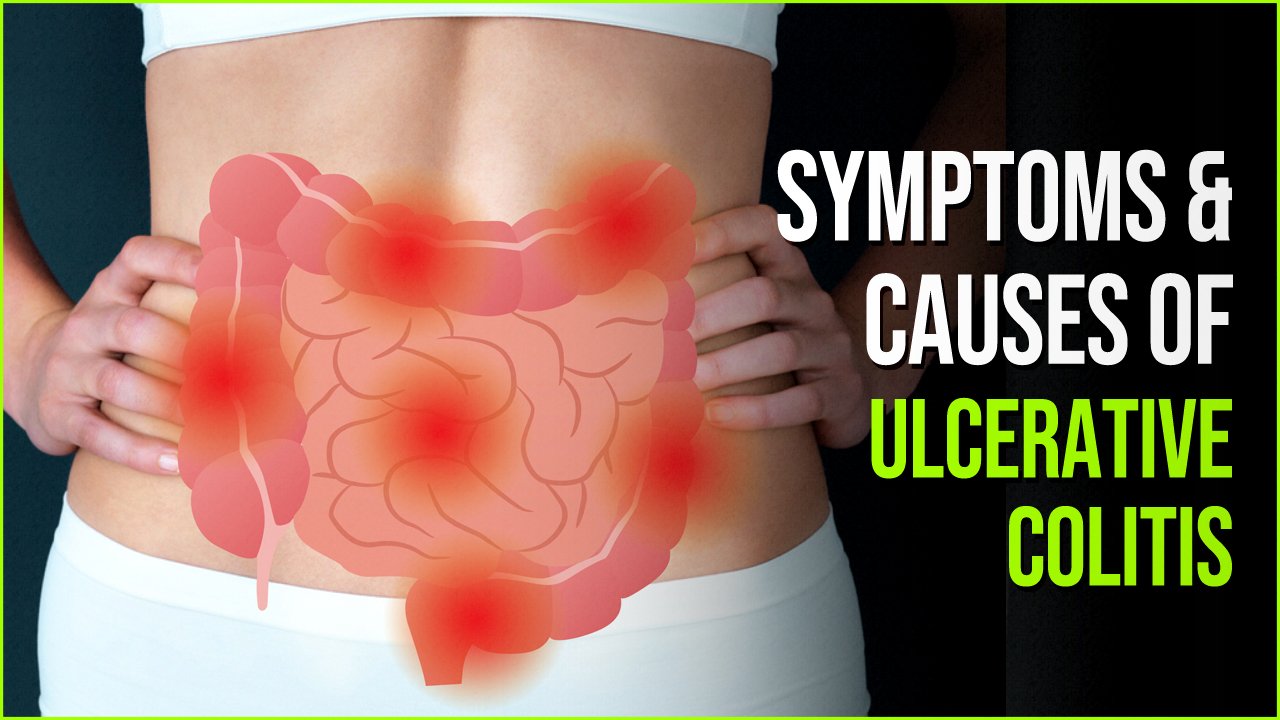 Ulcerative Colitis Truths About The Common Inflammatory Disorder 9763