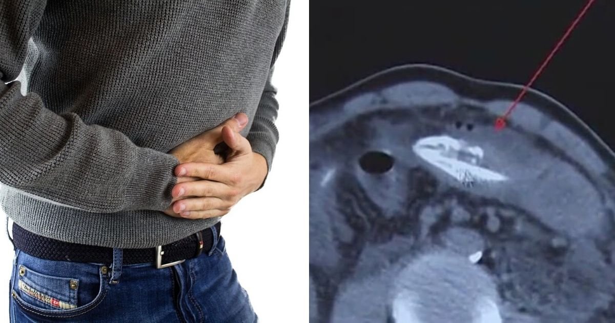 untitled design 8 2.jpg?resize=412,275 - Man Hospitalized After Inserting Eel In His Backside To Treat Constipation