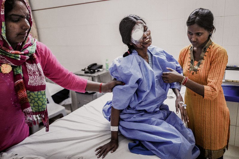 El drama de miles de mujeres en la India quemadas con ácido
