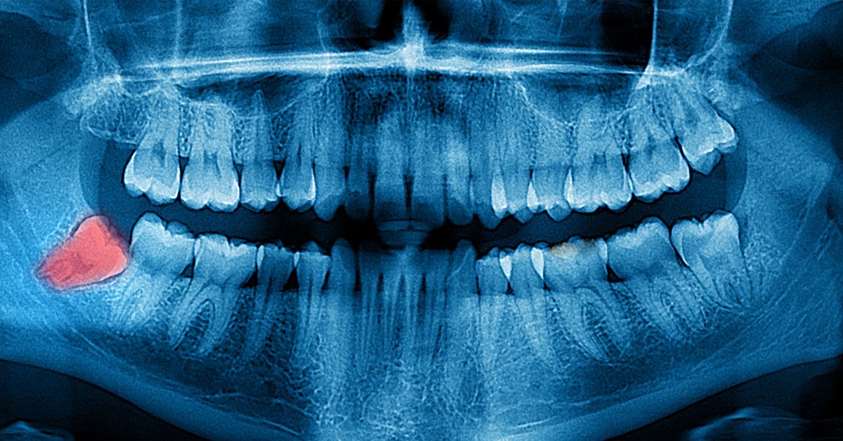 Muelas del juicio retenidas: ¿Cómo nos afectan? - IMED Dental