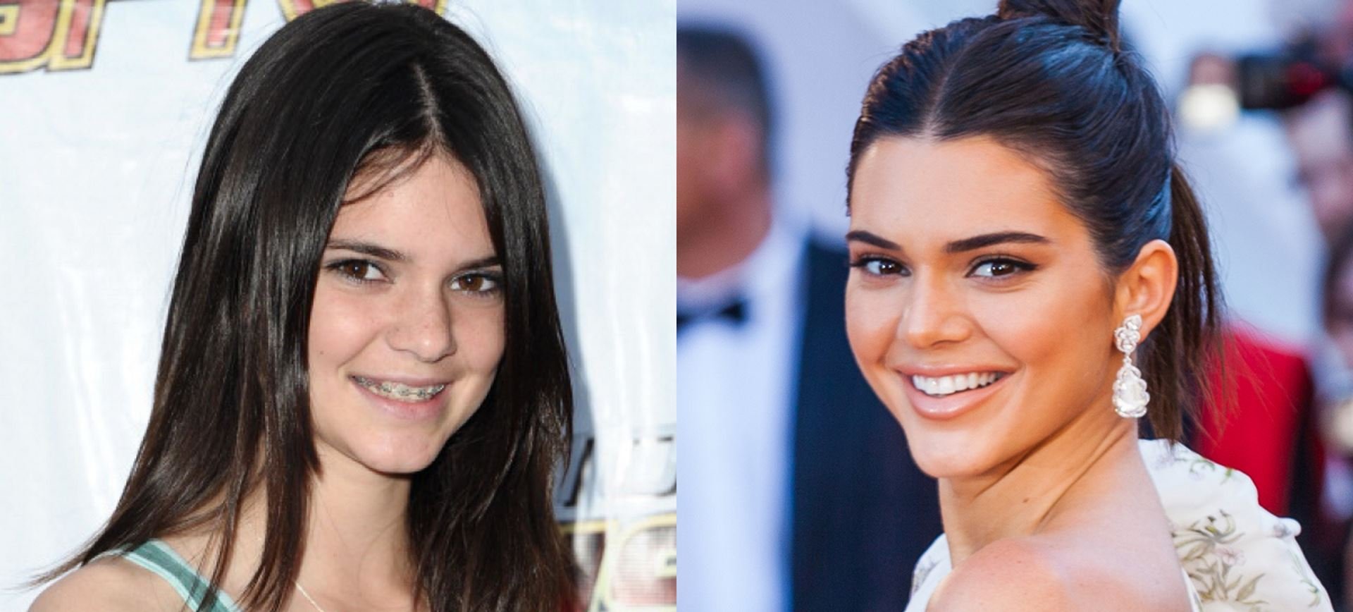 braces before and after