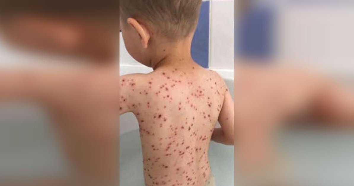 chickenpox.jpg?resize=1200,630 - Young Boy Cried Out In Pain, That