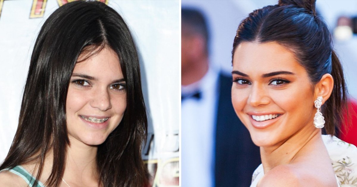 before and after braces.jpg?resize=412,232 - 10 Stars Whose Braces Before And After Images Define Hollywood Smile
