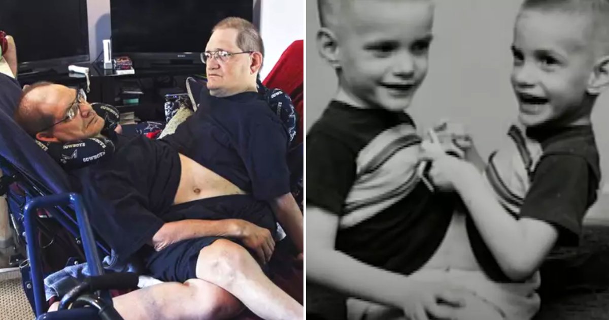 conjoinedtwins.png?resize=412,275 - The World's Oldest Conjoined Twins Have Passed Away Aged 68