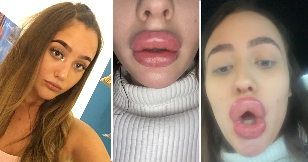 olivia mccann lips.jpg?resize=412,275 - Lip Filler Goes Wrong: Woman Forced To Hide Her 'Baboon’s Bum' Pout