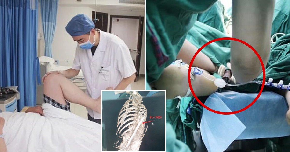 rod6.png?resize=412,275 - Construction Worker Cheated Death After Being Impaled By A Long Steel Rod