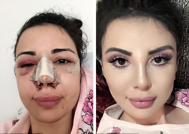 plastic surgery addict