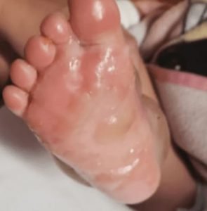 FOTOS: Abuela quema pies de su nieta de dos años con agua hirviendo