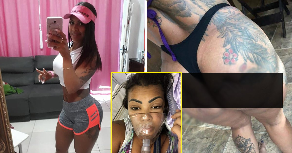 butt surgery.jpg?fit=1024%2C538&ssl=1&strip=all - Brazilian Butt Lift Goes Wrong As Mum Left With Holes In Her Bum