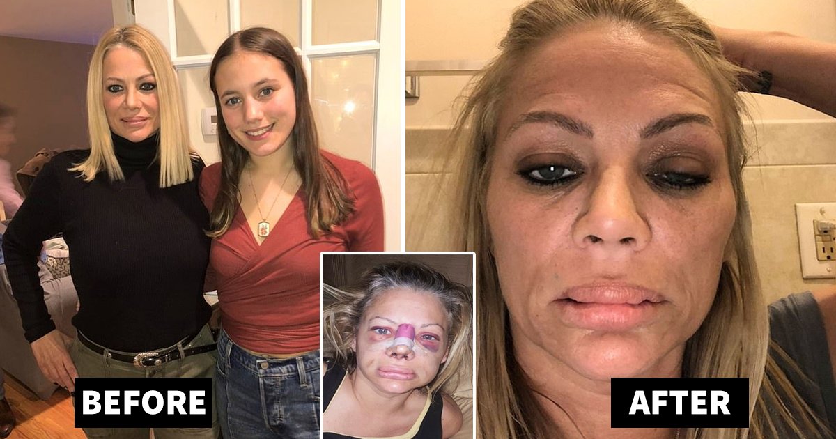 lip surgery.jpg?fit=1024%2C538&ssl=1&strip=all - Plastic Surgery Gone Wrong As Mom Left With Lumpy Lips And Misshaped Nose