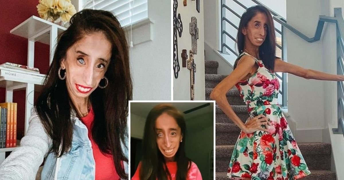 untitled design 15.jpg?resize=412,275 - Woman With Rare Disease Begs Parents To Stop Using Her Face To Scare Their Kids