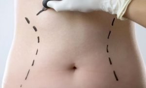 belly button removals