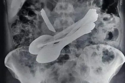 La radiografía que le tomaron al hombre (Foto: SWNS)