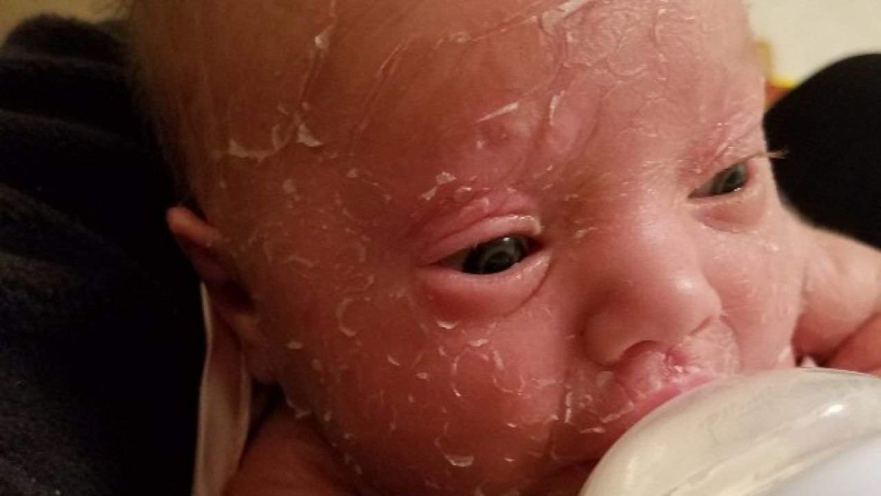 Una rara enfermedad obliga a unos padres a bañar a su hija con cloro para aliviar su piel