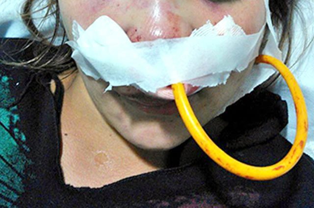 Un joven boxeador golpeó brutalmente a su novia embarazada y le desfiguró el rostro