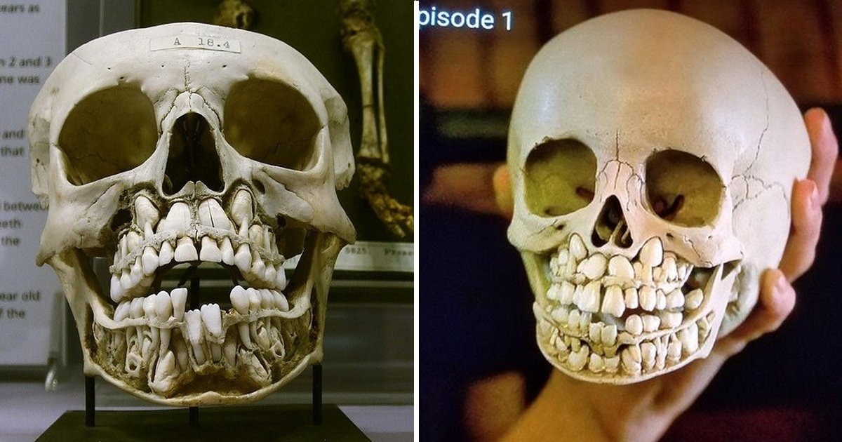 baby skull.jpg?resize=412,275 - These Photos Of A Child's Skull Full Of Teeth Will Absolutely Cringe You