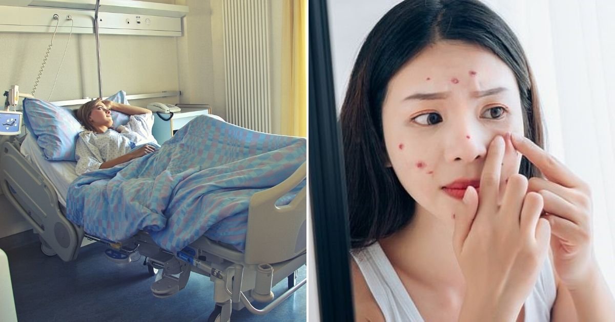 pimple5.jpg?resize=1200,630 - 19-Year-Old Girl Suffers Severe Brain Infection After Popping A Pimple On Her Nose