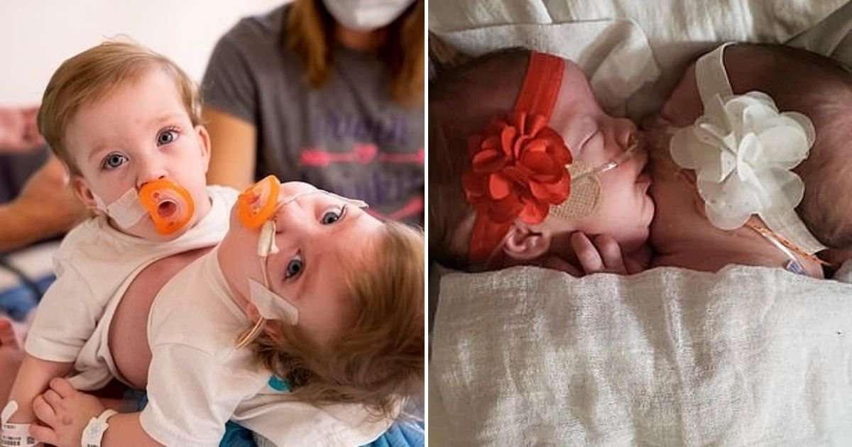 twins6.jpg?resize=412,275 - Conjoined Twins Born Hugging Each Other Are Successfully Separated After 11-Hour Surgery