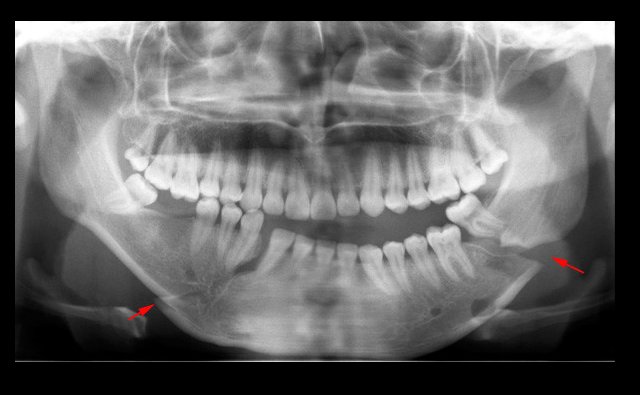 Caso Nº 265: FRACTURA MANDIBULAR – CDI Perú