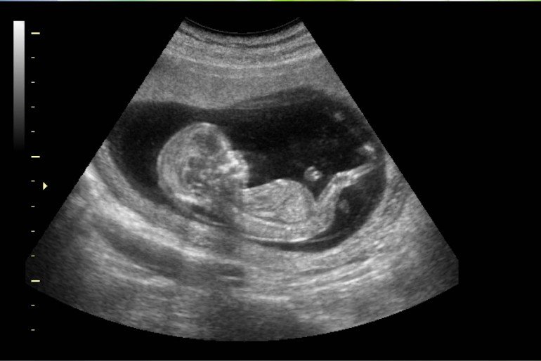 La ecografía fetal en el segundo trimestre: interés para el cirujano pediatra -