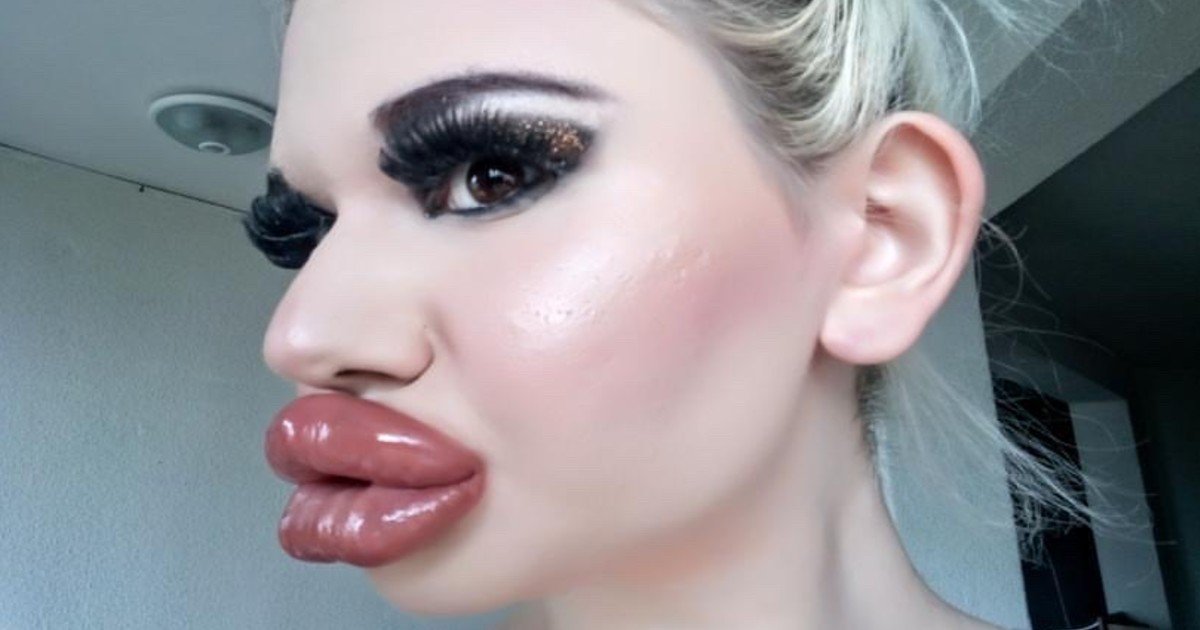 e18486e185aee1848ce185a6 2020 10 17t230346 620.jpg?resize=1200,630 - Woman Receives 17 Injections To Have Biggest Lips In The World