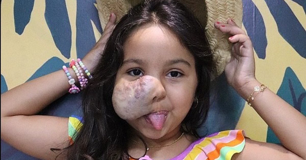 e18486e185aee1848ce185a6 4 3.png?resize=412,275 - 6-Year-Old Girl Born With A Large Facial Tumor Refuses To Look In A Mirror
