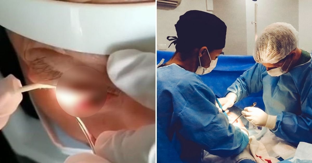 worm4.jpg?resize=412,275 - Man Has 20 Wriggling Worms Pulled Out From His Eye After Parasites Lived Inside For A Year