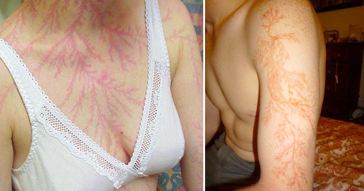 agagsaa.jpg?resize=412,275 - These Lightning Scars Explain What The Natural Disaster Does To Your Skin