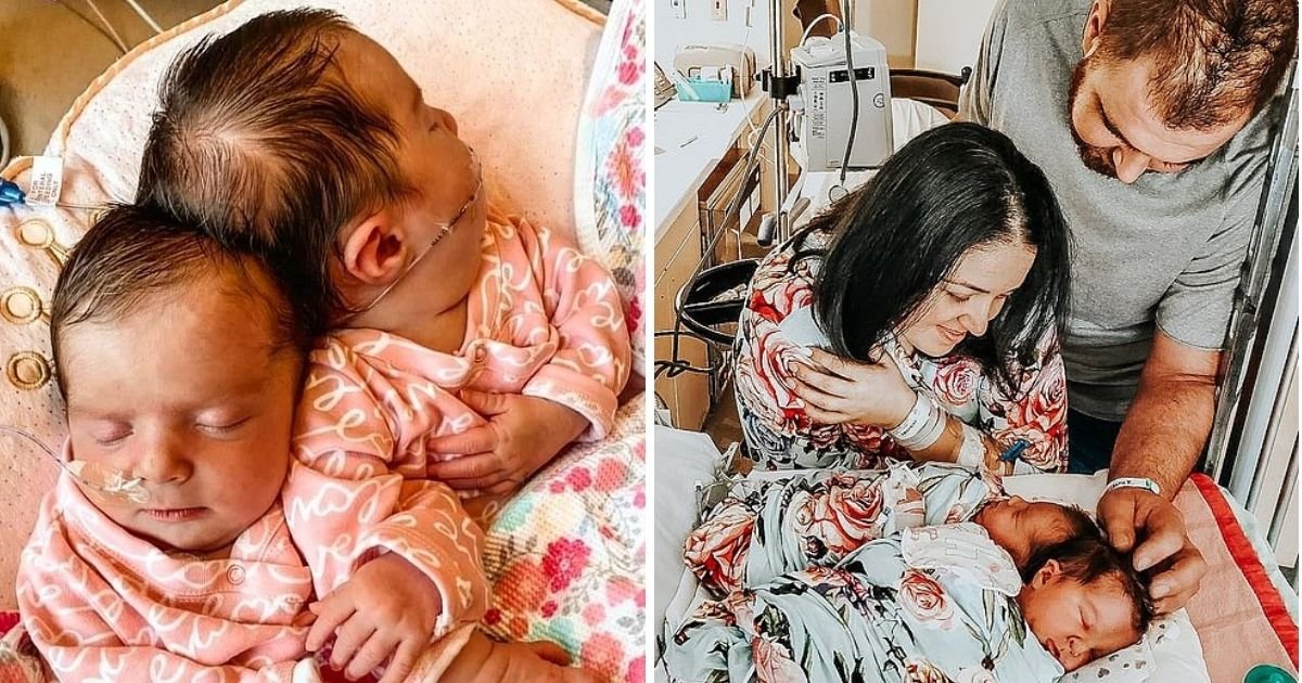 babies7.jpg?resize=412,232 - Parents Of Twins Who Were Born Sharing A Skull And Brain Open Up About Their Emotional Journey
