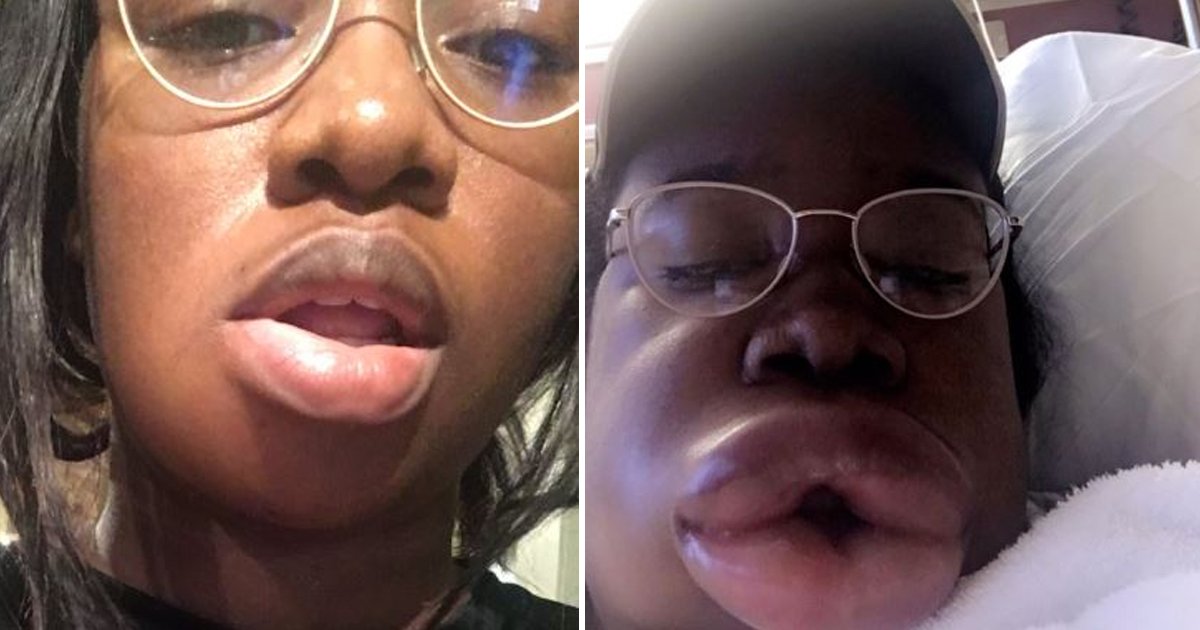 hadfadsf.jpg?resize=1200,630 - Meat Lip Queen: Say Hello To The Teen Whose Lips Quadrupled After Eating Hamburgers