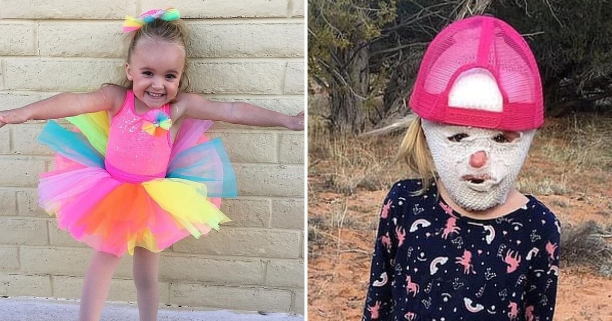 rawkee7.jpg?resize=412,275 - 4-Year-Old Girl Suffered Excruciating Burns On Her Body And Face In An Accident That Melted Her Skin